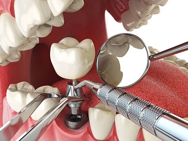 Best Chipped Tooth Repair Near Me  in Apollo, PA